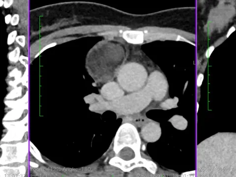 Người phụ nữ phát hiện ‘u quái’ có tóc, xương kỳ lạ: BS chỉ ra các dấu hiệu phát hiện