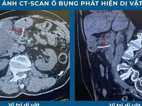 Cụ ông suýt chết vì bị xương cá xuyên thủng dạ dày