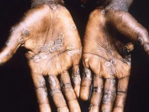 Mỹ chi hơn 100 triệu USD mua vắc xin phòng bệnh đậu mùa khỉ