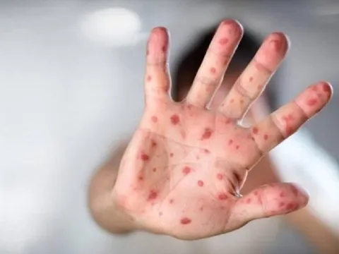 Đã có 5.545 ca mắc tay chân miệng, Bộ Y tế chỉ đạo khẩn