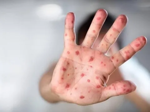 Một ca tử vong vì dịch tay chân miệng, Bộ Y tế cảnh báo