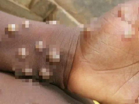 Lo ngại virus đậu mùa khỉ sẽ nối tiếp đại dịch COVID-19