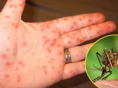 Lo sốt xuất huyết, tiêu chảy, tay chân miệng... có thể bùng phát, Bộ Y tế ra công điện