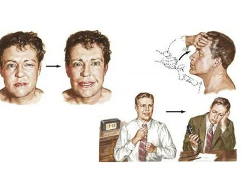 Căn bệnh gây sụp mí mắt, bủn rủn tay chân, suy hô hấp nặng âm thầm, có thể tử vong