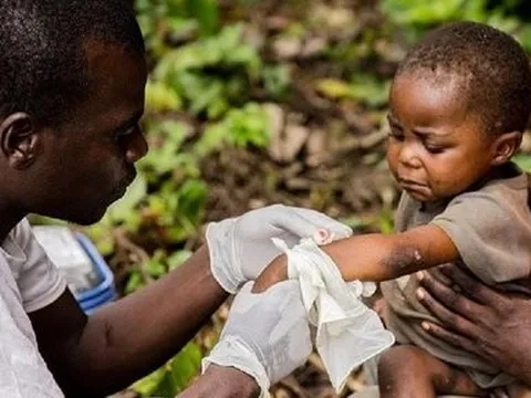 Triệu chứng và mức độ nguy hiểm của bệnh đậu mùa khỉ