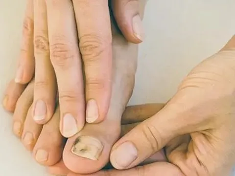 Người phụ nữ phát hiện bệnh nghiêm trọng nhờ điểm lạ ở ngón chân