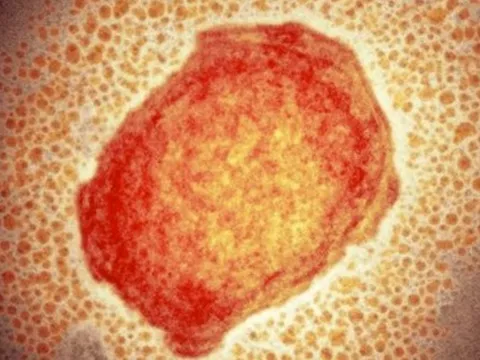 Bệnh đậu mùa khỉ: Virus gây bệnh nguy hiểm như thế nào?