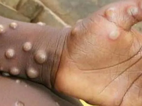 12 quốc gia ghi nhận bệnh đậu mùa khỉ, Việt Nam theo dõi sát sao, giám sát chặt