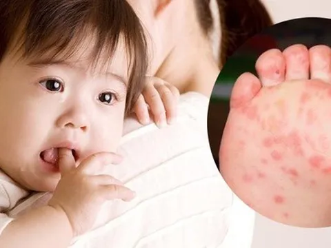 Những điều cha mẹ cần lưu ý khi chăm sóc trẻ mắc bệnh tay chân miệng