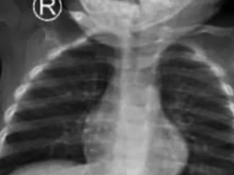 Ruột non bệnh nhi thủng 5 lỗ vì món đồ chơi nguy hiểm