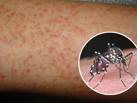 TP. Hồ Chí Minh: Thêm 1 ca tử vong do sốt xuất huyết, số ca mắc mới tăng 20%