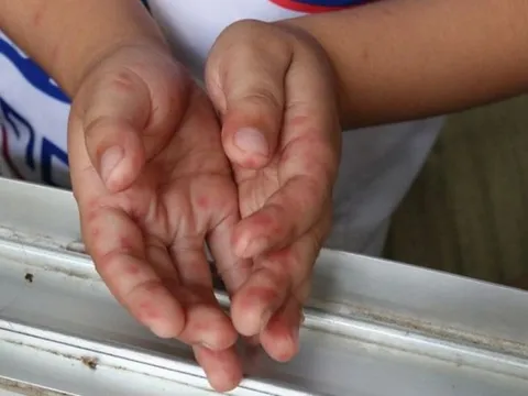 Bác sĩ chỉ ra dấu hiệu cảnh báo trẻ em mắc tay chân miệng trở nặng