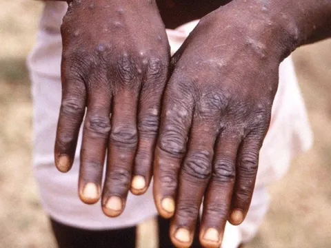 Chuyên gia y tế khuyến nghị cách phòng bệnh đậu mùa khỉ