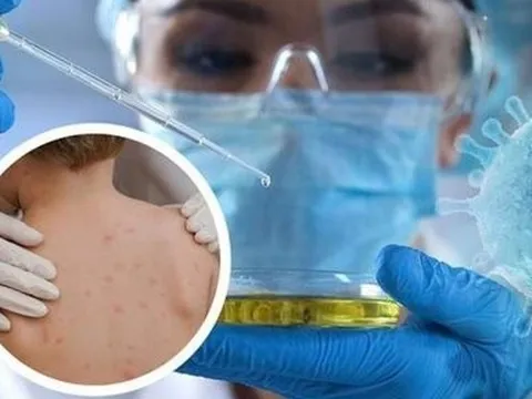 Dịch đậu mùa khỉ phức tạp, Việt Nam giám sát người đến từ 12 quốc gia lưu hành ca bệnh