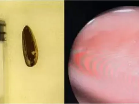 Bé 9 tháng suýt mất mạng vì bị sặc loại hạt quen thuộc