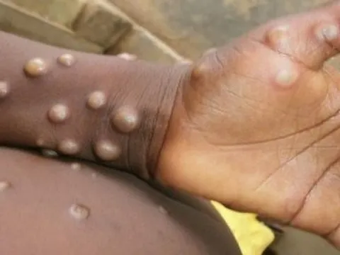 Giám sát, phát hiện ca nghi ngờ bệnh đậu mùa khỉ tại cửa khẩu