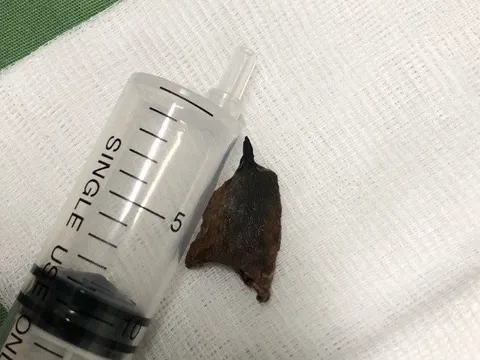 Người đàn ông ho ra máu dai dẳng do hóc xương lợn 20 năm