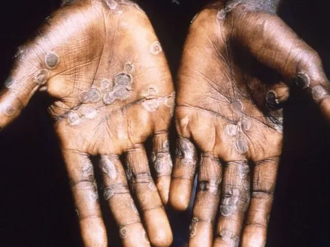 Nhiều nước ráo riết săn lùng vắc-xin và thuốc chữa đậu mùa khỉ