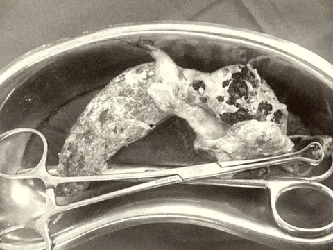 Phẫu thuật lấy thành công búi tóc trong ruột bé gái do hội chứng Rapunzel