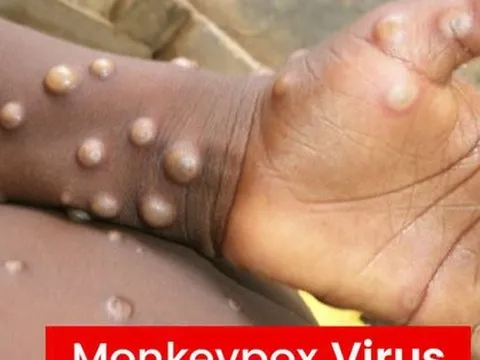 Lo ngại bùng phát dịch bệnh đậu mùa khỉ sau hơn 40 năm kết thúc tiêm phòng