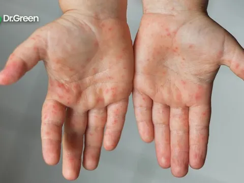 Bệnh tay chân miệng lan rộng: BS chỉ ra những sai lầm cha mẹ hay mắc khi chăm sóc trẻ