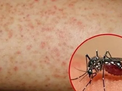 Coi chừng biến chứng nguy hiểm của sốt xuất huyết ngày mưa