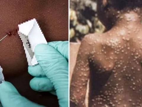 Bộ Y tế khuyến cáo 6 biện pháp phòng chống bệnh đậu mùa khỉ đang 'nóng' tại nhiều quốc gia