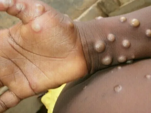 Bệnh đậu mùa khỉ bùng phát tại nhiều quốc gia: Nhóm chuyên gia chỉ ra điều bất thường