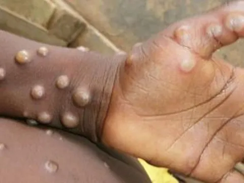 4 hiểu nhầm thường gặp về bệnh đậu mùa khỉ