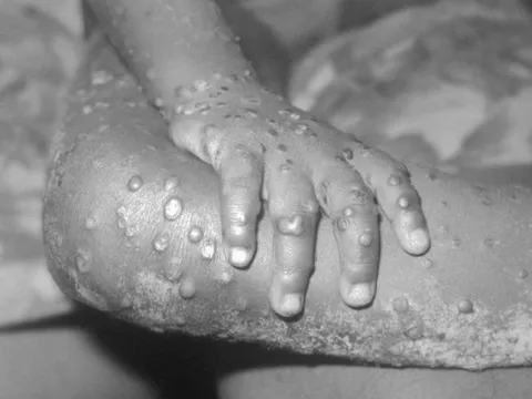 Thú cưng có thể là vật chủ trung gian lây bệnh đậu mùa khỉ