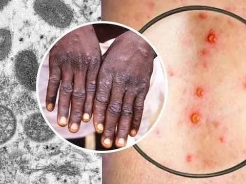 [Infographic] Làm thế nào để phòng chống bệnh đậu mùa khỉ