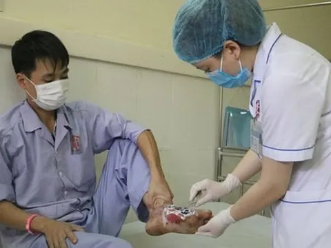 Hoại tử bàn chân do chữa bỏng theo lời thầy lang