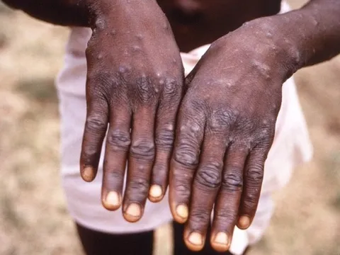 Chuyên gia y tế thế giới: Đậu mùa khỉ bình phục sau 2-4 tuần