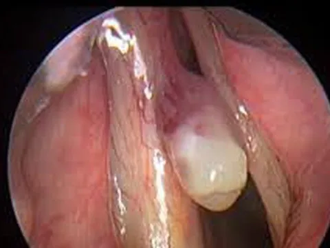 Giọng nói thay đổi cảnh báo bệnh gì?