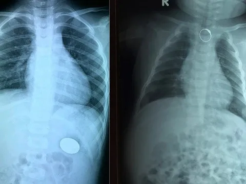 Cẩn trọng khi trẻ nuốt phải dị vật