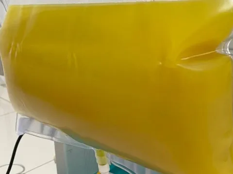 Cấp cứu 2 bệnh nhân nguy kịch do viêm tụy cấp