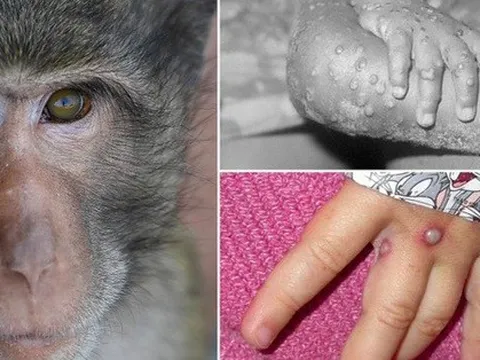 Dịch đậu mùa khỉ lây lan nhanh ở hơn 20 quốc gia, Việt Nam làm gì để ứng phó?