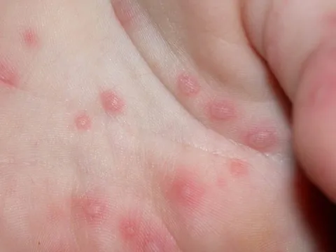Bệnh tay chân miệng tưởng lầm đậu mùa khỉ