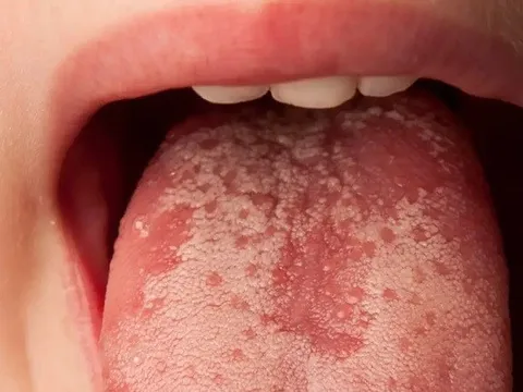 Đốm trắng trên lưỡi có thể là dấu hiệu của những điều này