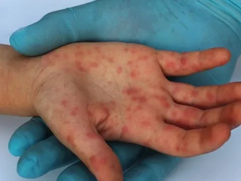 Bác sỹ gợi ý cách chăm sóc và phòng ngừa bệnh sốt xuất huyết cho trẻ