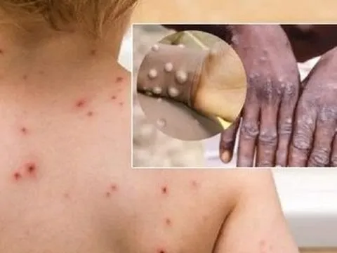 Chuyên gia chỉ cách phân biệt bệnh đậu mùa khỉ với thủy đậu