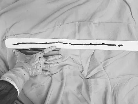 Lấy đoạn huyết khối dài hơn 80cm giúp bệnh nhân khỏi nguy cơ bị cắt chân