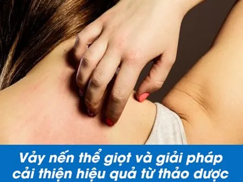 Vảy nến thể giọt và giải pháp nhờ Kim Miễn Khang & Explaq