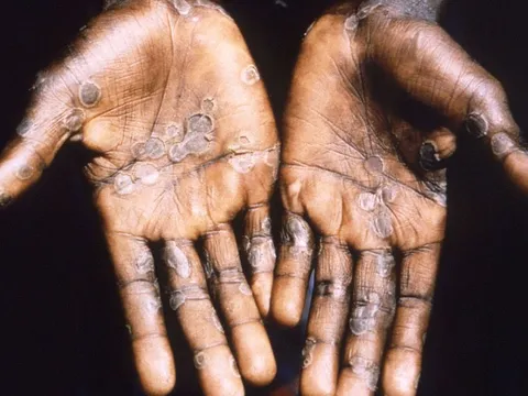 Đậu mùa khỉ bất ngờ bùng phát tại nhiều nước: Chuyên gia nêu lý do không cần hoảng loạn