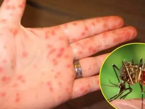 Dấu hiệu chứng tỏ trẻ sốc sốt xuất huyết và cách xử trí đúng