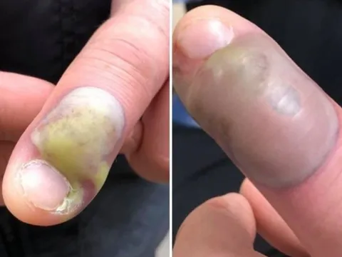 Thường xuyên có thói quen xấu này, bé trai suýt phải cắt cụt tứ chi