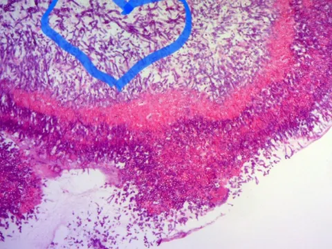 Bệnh nhân 60 tuổi tử vong sau khi ăn món "đặc sản"