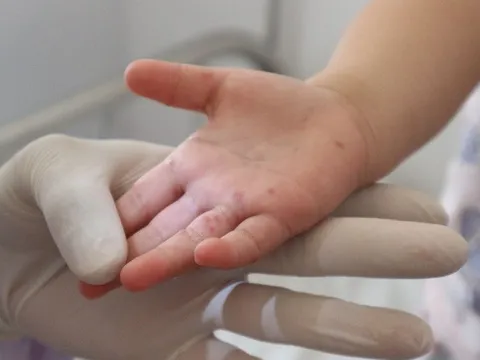 TP. Hồ Chí Minh: Số ca mắc tay chân miệng tăng hơn 19%