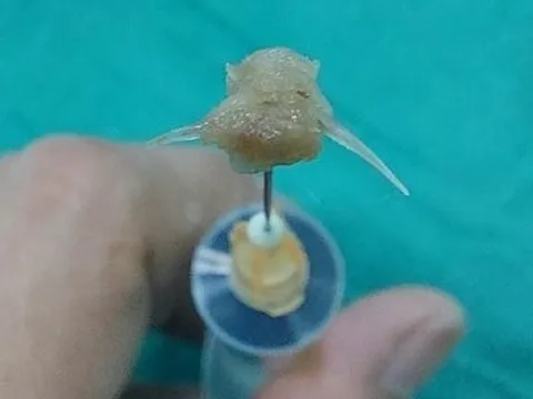 Xương cá găm sâu vào thành thực quản bé 2 tuổi