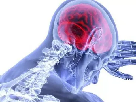 21 phút làm điều này, giảm nguy cơ đột quỵ 40%